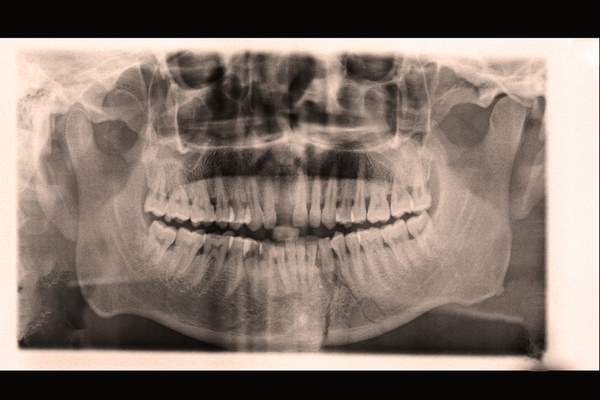 Parodontite radiografia