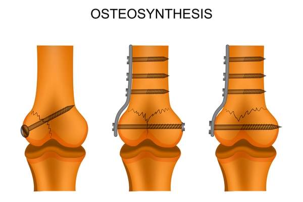 osteosintesi procedura