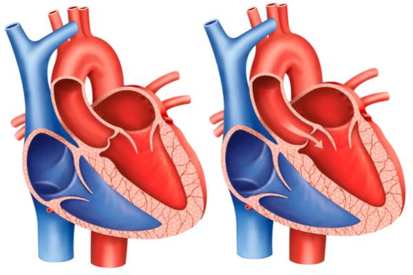diagnosi stenosi aortica