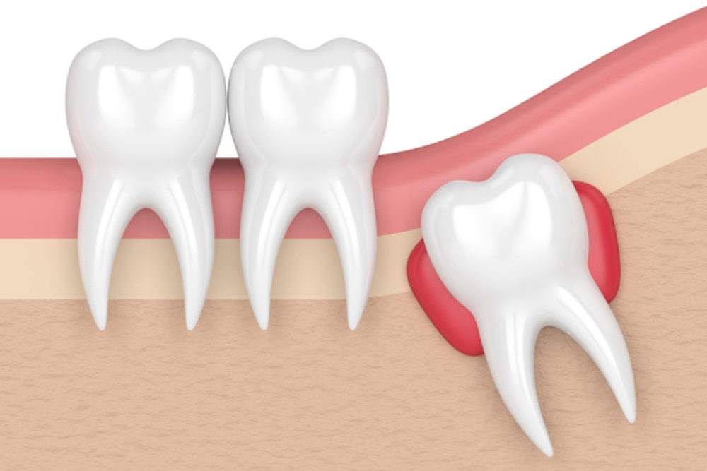 Illustrazione cisti dentale