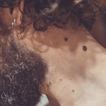 Uomo castano riccio che analizza un neo gonfio comparso sul collo