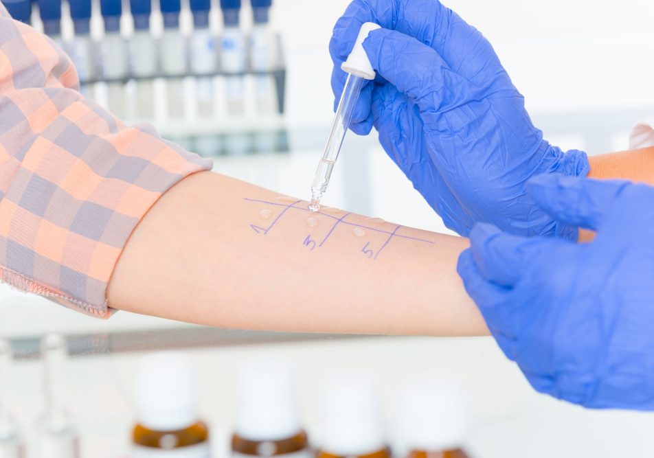 Uomo che sta facendo il prick test per le allergie