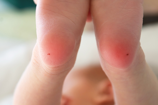 Bebè in ospedale su cui è stato eseguito un prelievo del sangue nei talloni per sottoporlo allo screening neonatale per la fibrosi cistica