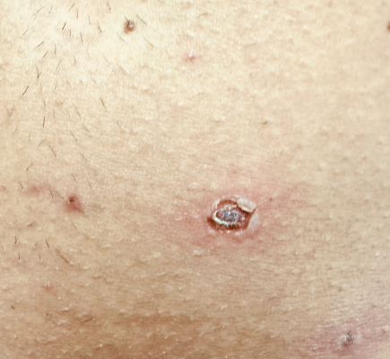Pelle di uomo con sintomi leishmaniosi cutanea