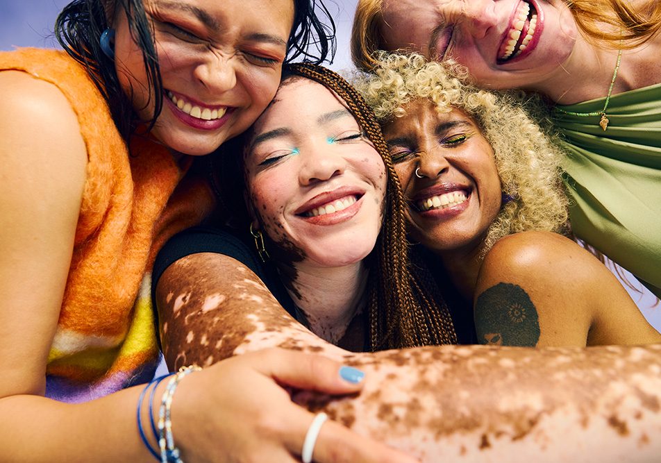 Ragazze allegre che si abbracciano convivono con una situazione di salute comune essendo in cura dalla vitiligine
