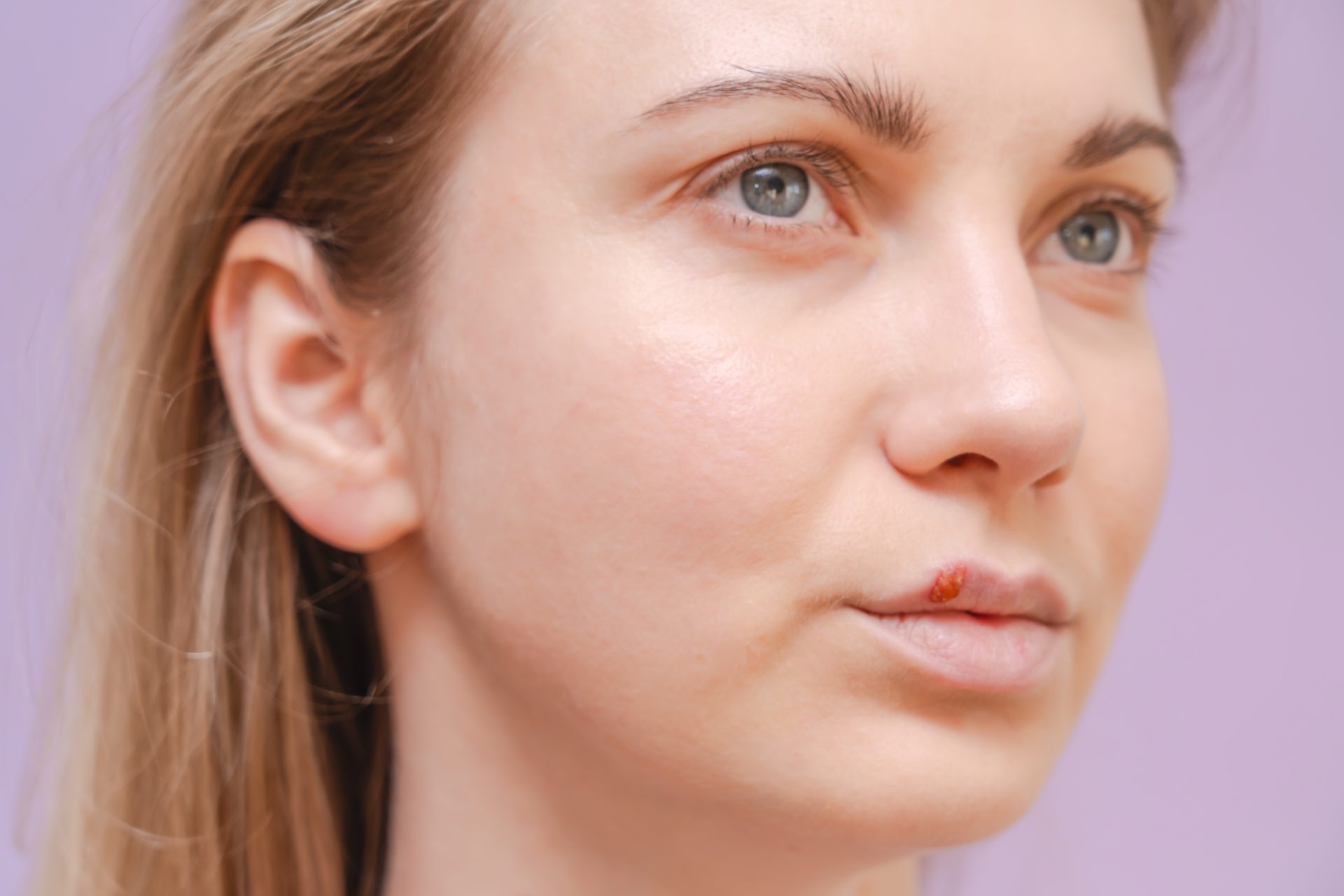 giovane donna con herpes labiale