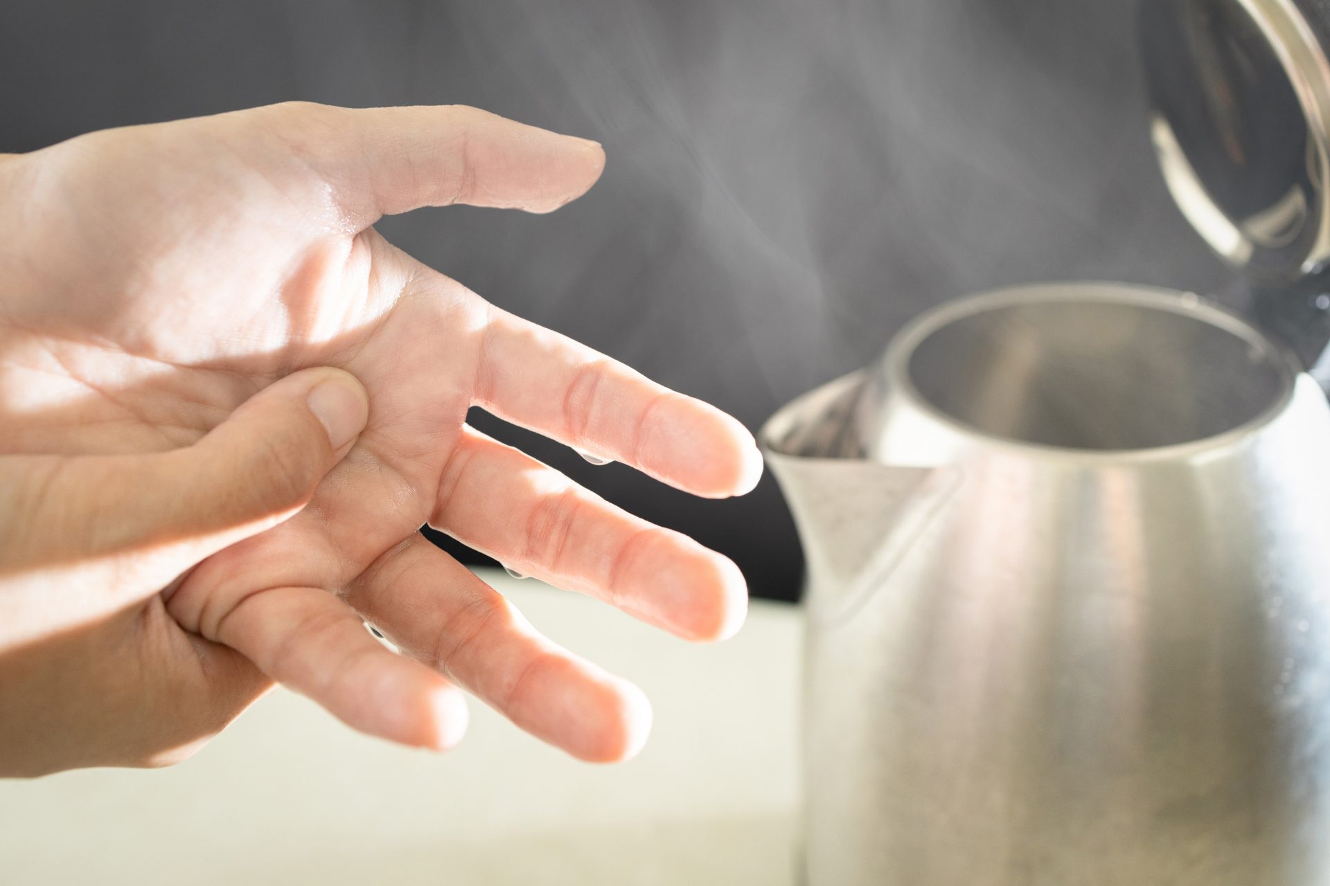 mano ustionata da bollitore