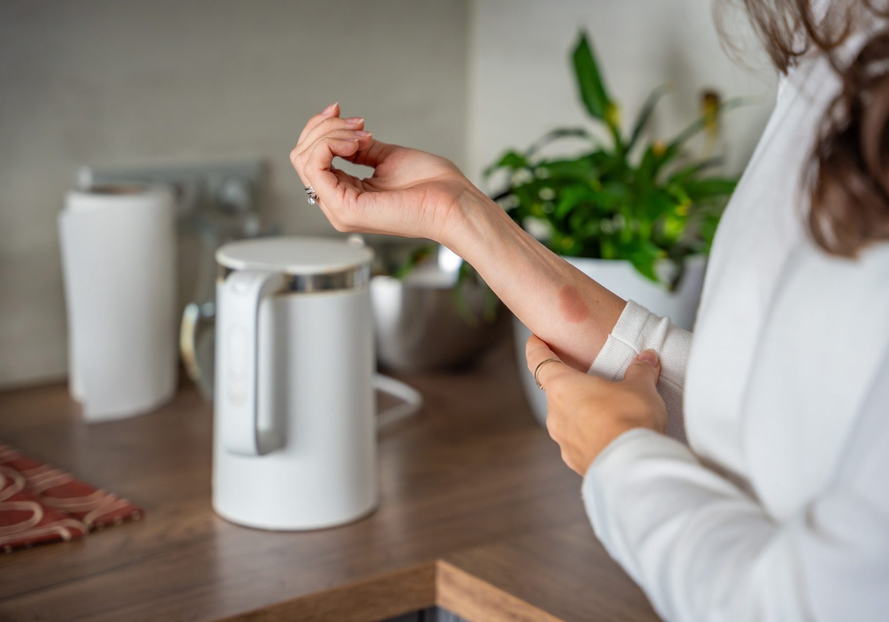 donna con scottatura sul braccio