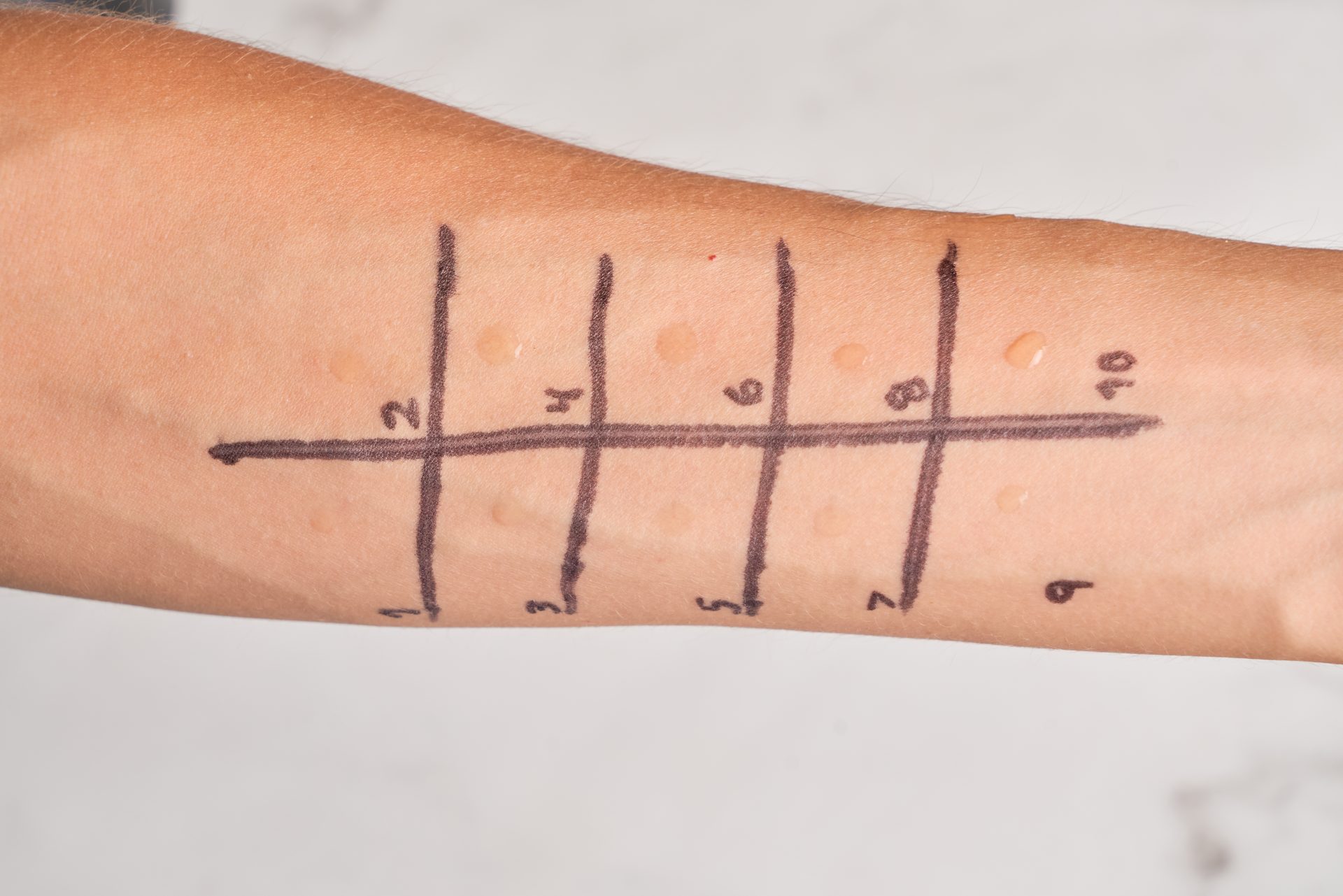 avambraccio sottoposto a prick test