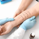prick test