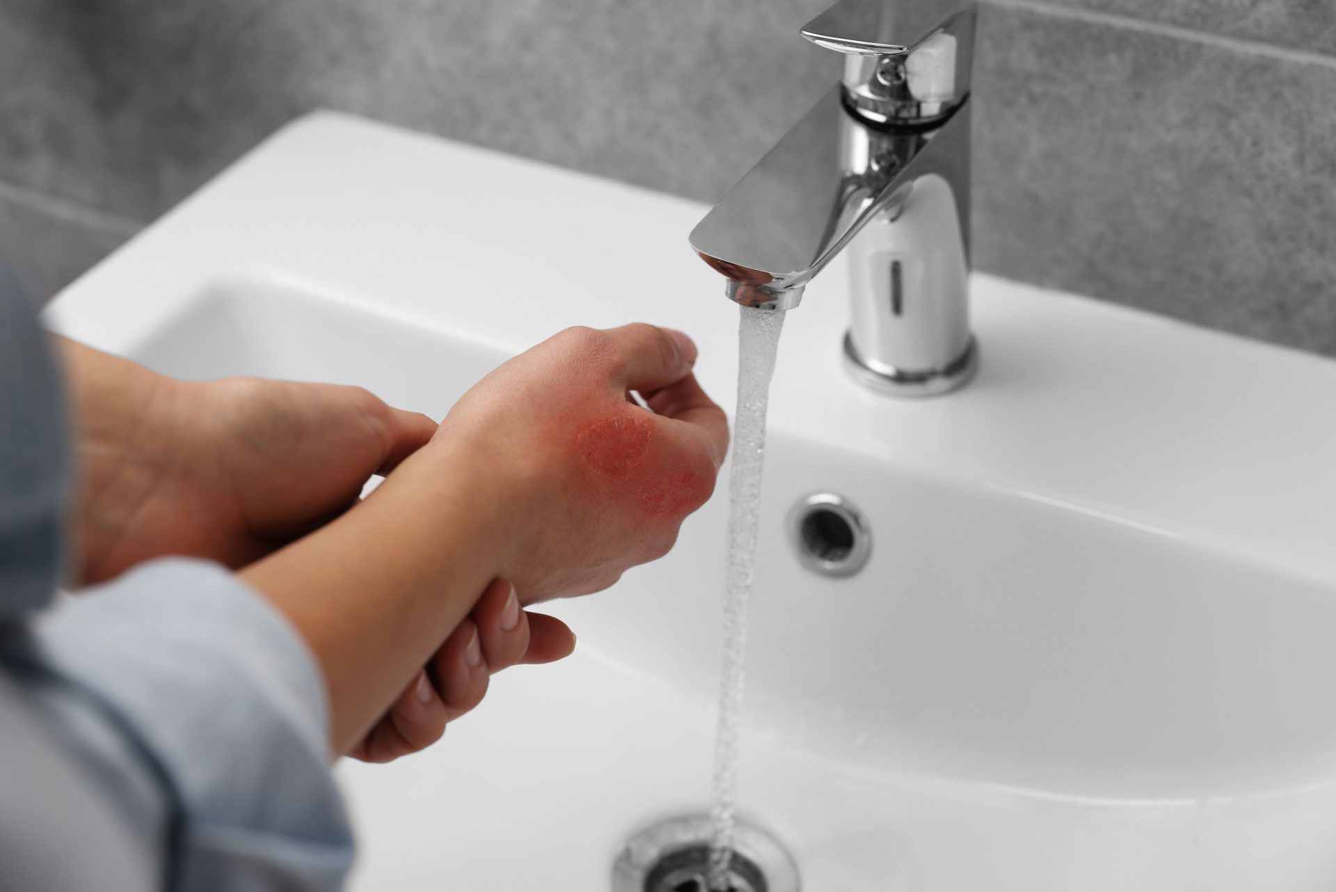 donna mette mano ustionata sotto acqua del rubinetto