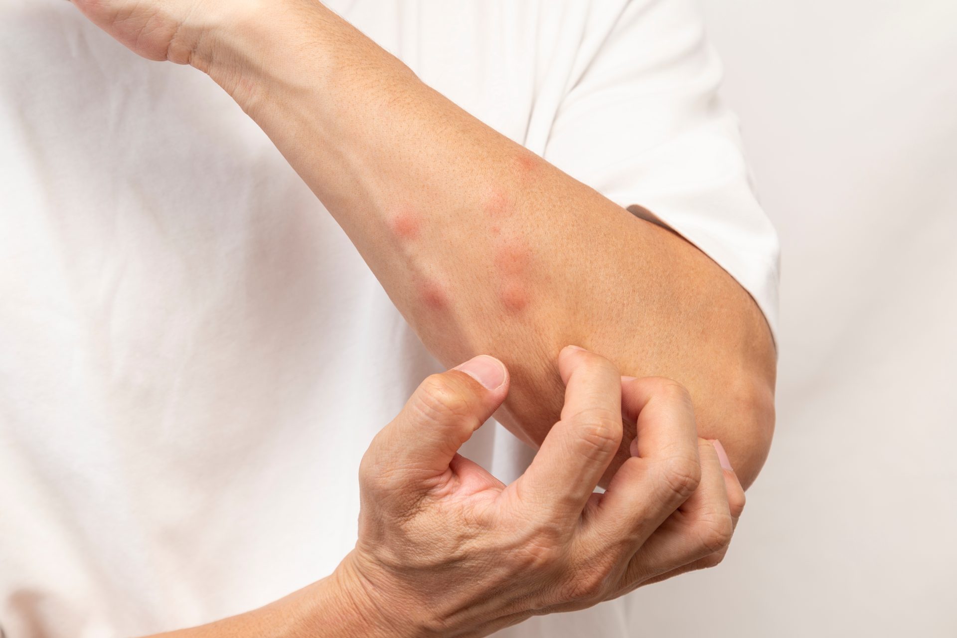 uomo si gratta l'avambraccio a causa di una puntura di insetto