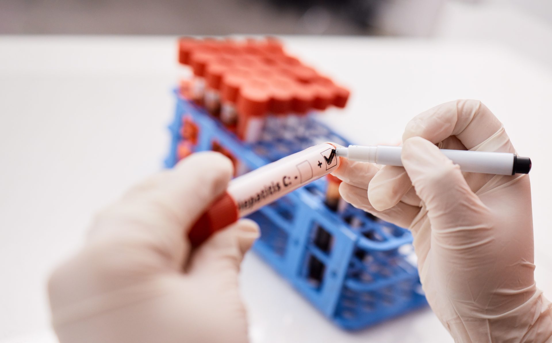 provetta per test epatite