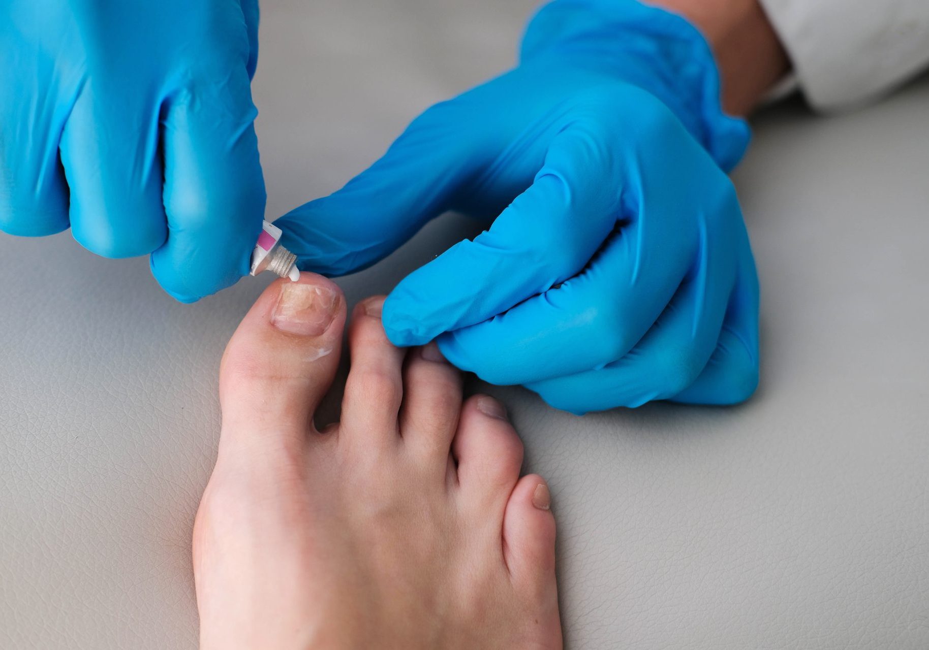 medico applica pomata contro una micosi dell'unghia dell'alluce
