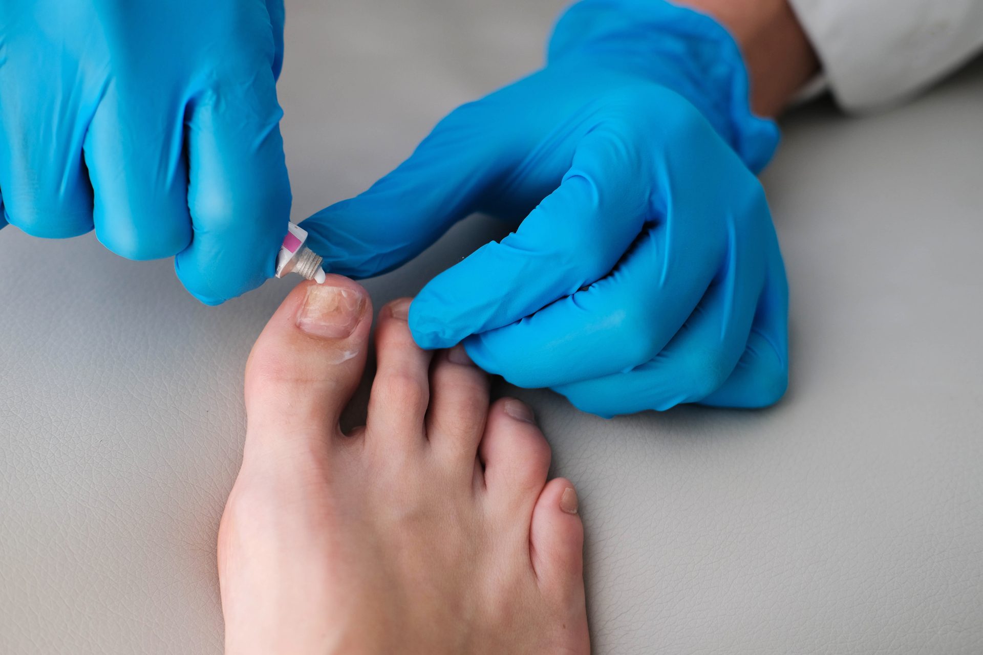 medico applica pomata contro una micosi dell'unghia dell'alluce