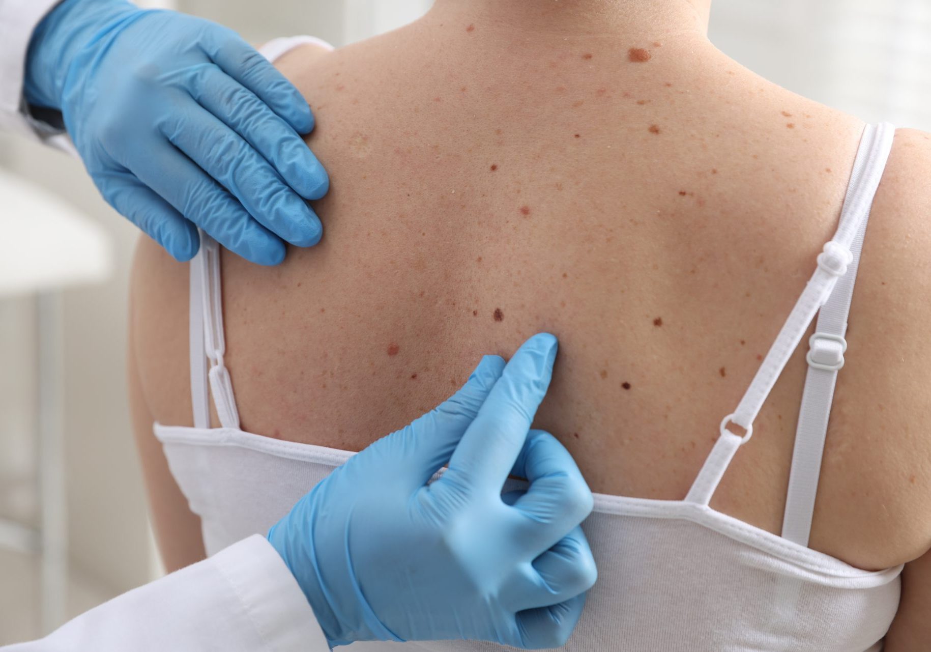 dermatologo controlla neo sulla schiena di una paziente