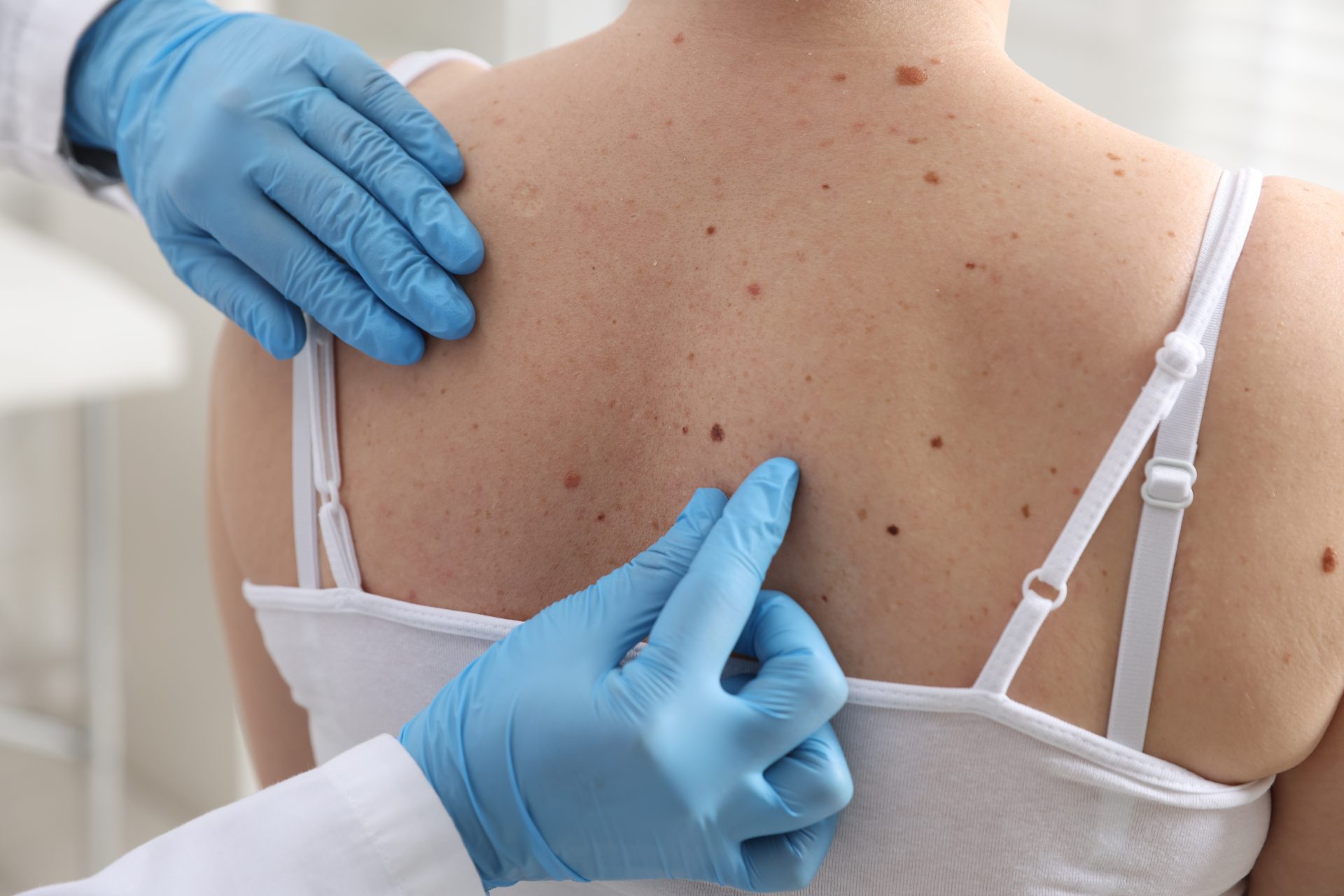 dermatologo controlla neo sulla schiena di una paziente